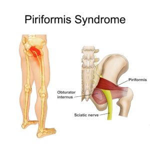 Piriformis muscle runners