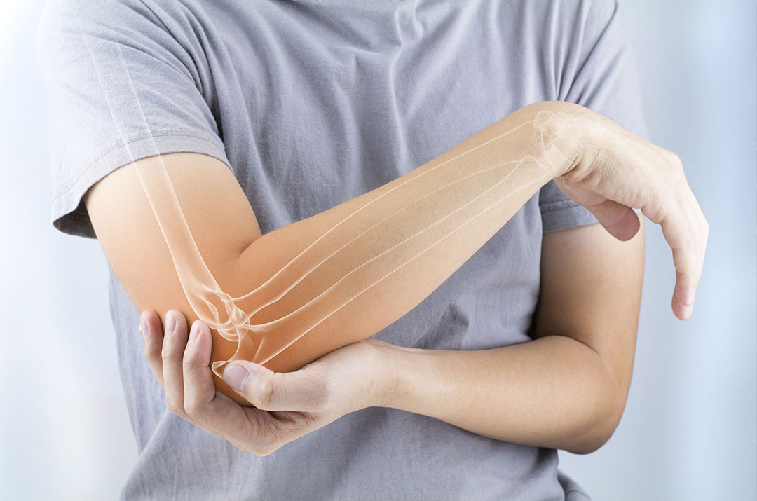 Elbow Gout - التهاب المفاصل الناتج عن ترسب حمض اليوريك في الكوع